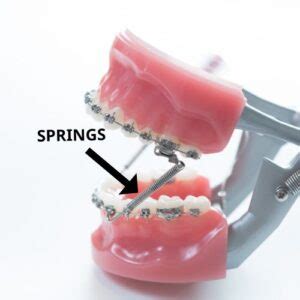 metal brackets act as springs keys|springs in a brace.